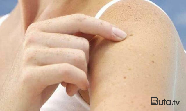  Rumıniyada qızılca epidemiyası elan edildi  